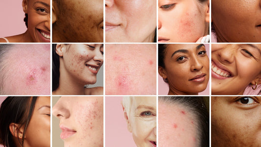 It's Acne Awareness Month - Give Me Cosmetics