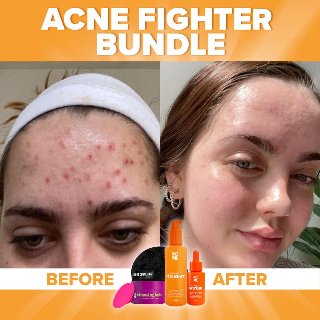 The Acne Fighter Bundle - Give Me Cosmetics